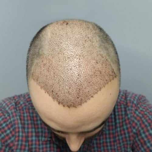 قبل و بعد عملية زراعة الشعر عند الرجال 