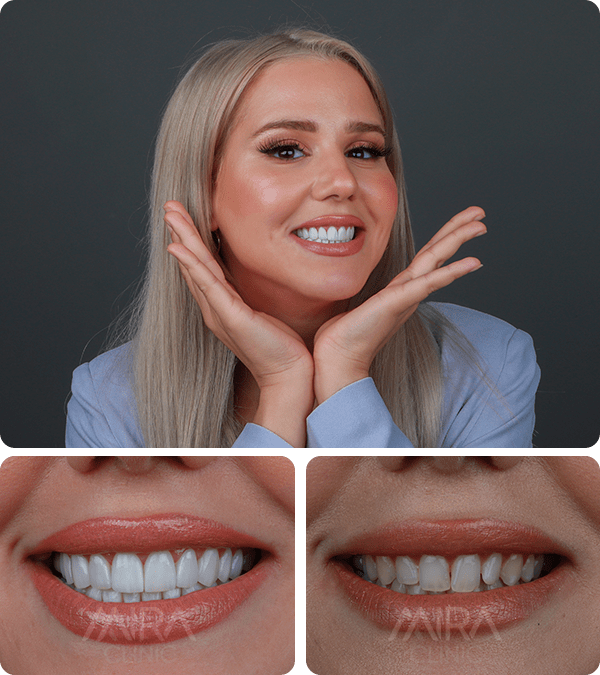 قبل و بعد عملية تجميل الأسنان 