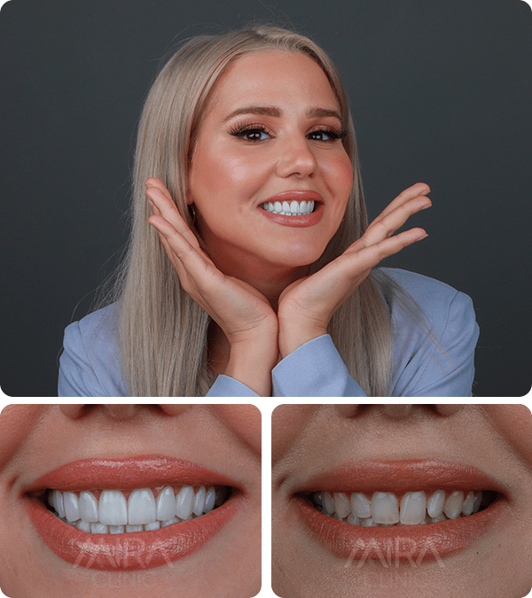 before and after hollywood smile and veneers 