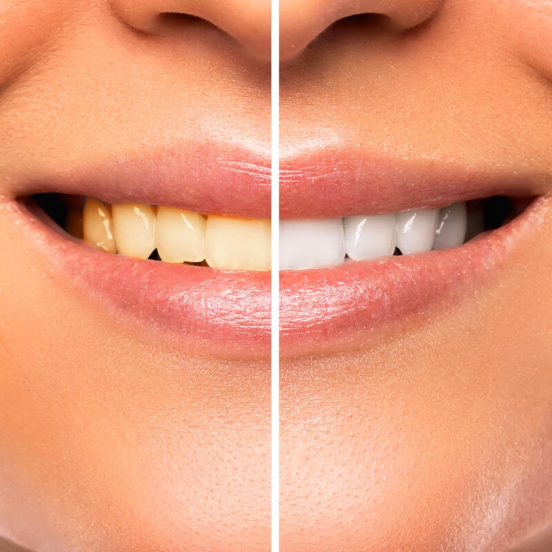 Teeth whitening cost in Turkey