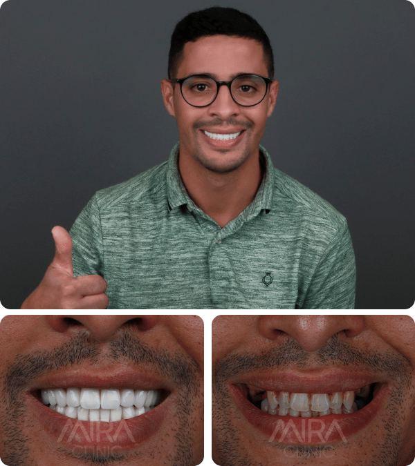 قبل و بعد عملية تجميل الأسنان