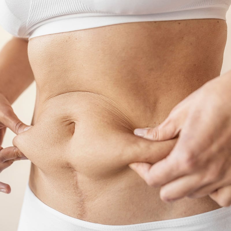 Liposuction Cost in Turkey