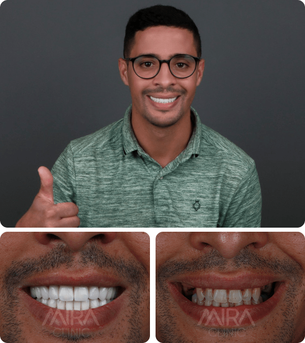before and after hollywood smile