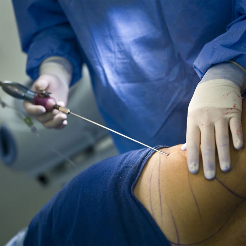 Is liposuction dangerous?