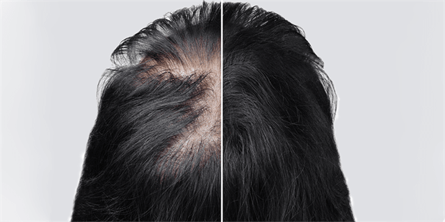 Hair transplantation for women in turkey 2023