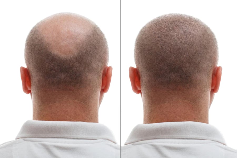 hair transplant for men 2023 in turkey