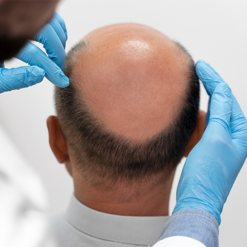 hair transplant in Turkey