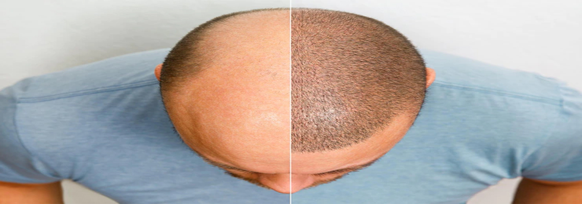 Mira-clinic | The difference between natural and artificial hair  transplantation