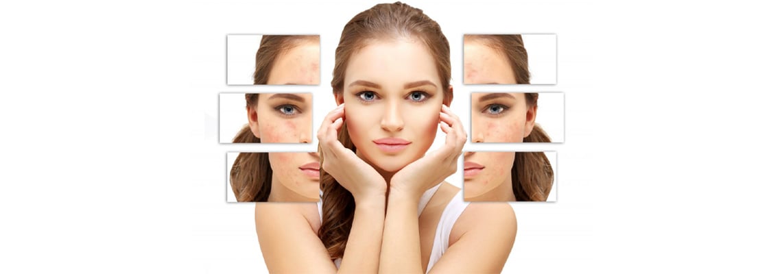 Can a facelift eliminate acne scars?