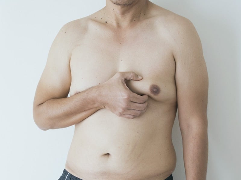 Are there any non-surgical treatment options for gynecomastia?