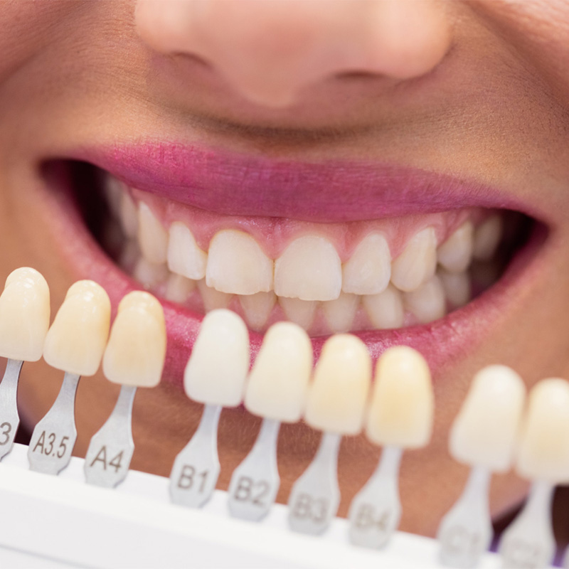 Décoloration des dents ou taches : types, causes, traitement et prévention