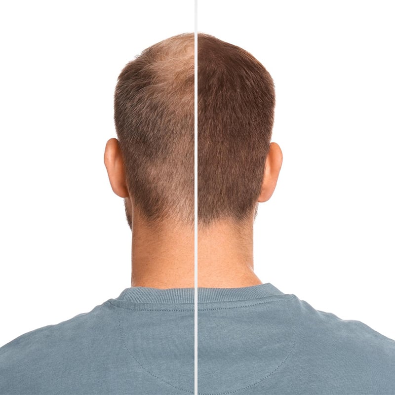 Best Hair Transplant Techniques in Turkey