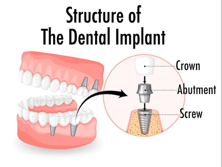 dental crowns in turkey 2023