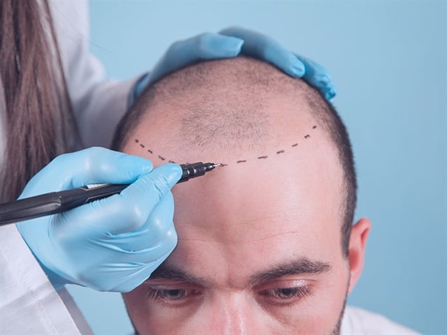 Instructions before the hair transplant procedure