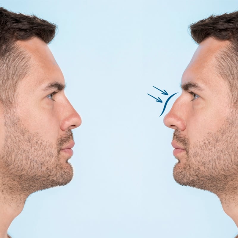 Rhinoplasty price in Turkey