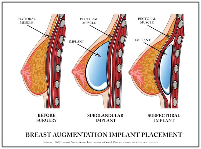 types of breast lift