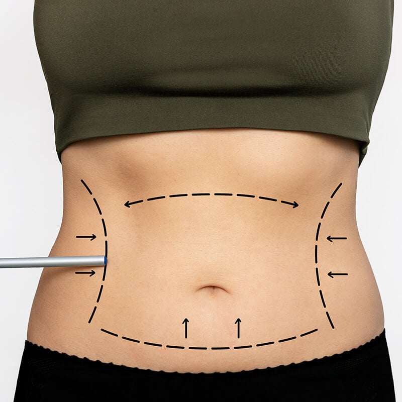 Coût de l’abdominoplastie en Turquie