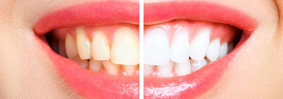 Teeth-discoloration-or-stains-types-causes-treatment-and-prevention