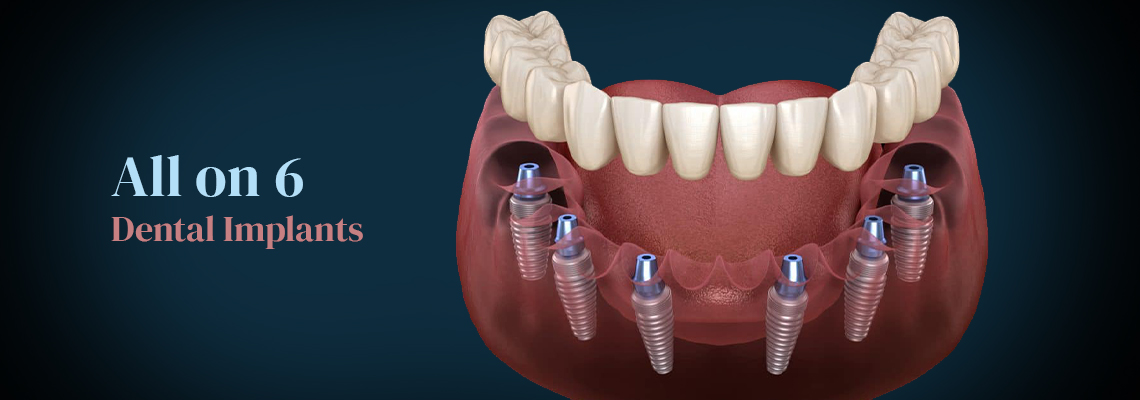 All-on-6 dental implant procedure in turkey