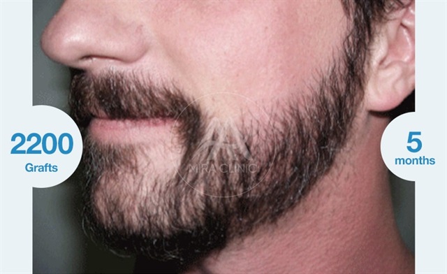Before & After Beard Hair Transplantation
