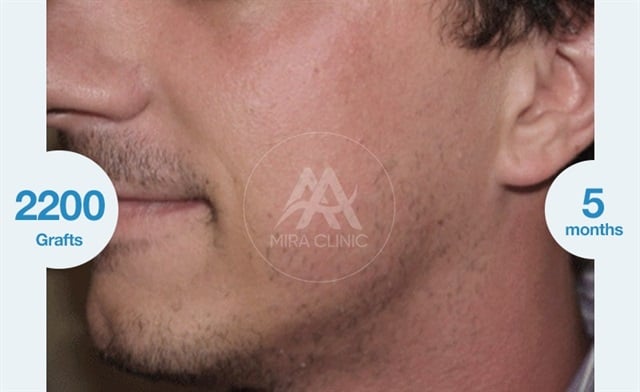 Before & After Beard Hair Transplantation 