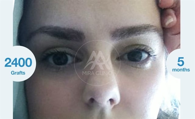 Before & After Eyebrow Hair Transplantation