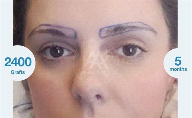 Avant après Les sourcils sont denses et plantés 