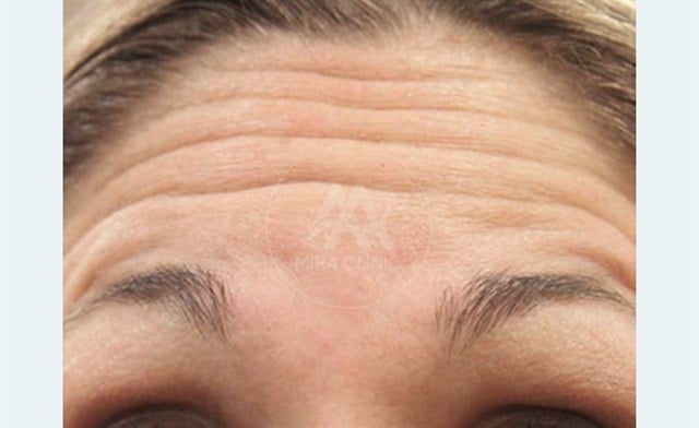 Filler Injection in Turkey 2025: Procedure, Healing Process, Benefits and Costs