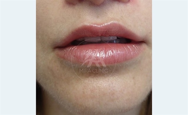 Before & After Lip Augmentation
