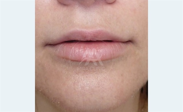 Before & After Lip Augmentation 