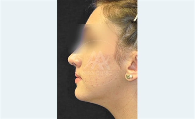 إجراء تكساس لتجميل الفك في تركيا 2025: الإجراء، عملية التعافي، والتكاليف