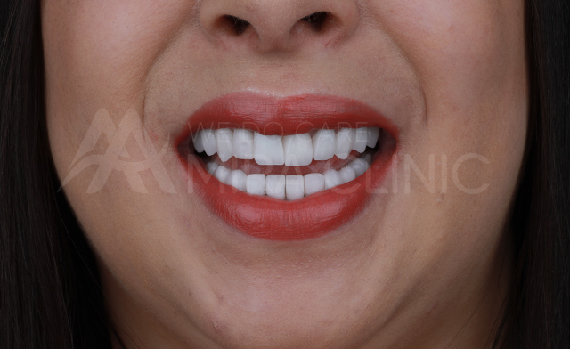 Before & After Hollywood Smile