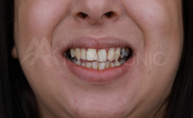 Before & After Hollywood Smile 