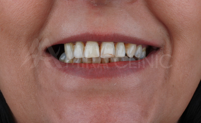 Before & After Dental Implant 