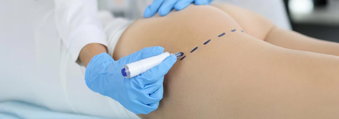 Tout savoir sur la chirurgie du lifting des fesses