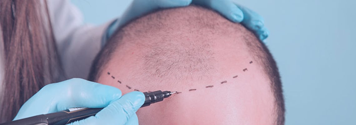 FUE hair transplant in Turkey