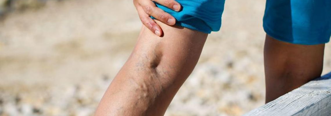 Laser treatment of varicose veins and heavy legs