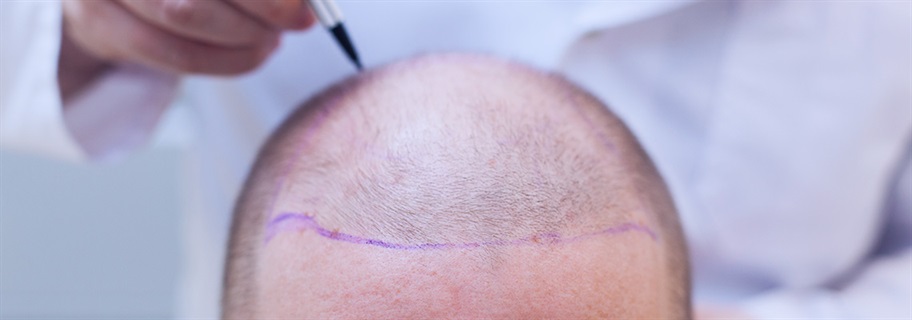 Pre & Post hair transplant instructions 2024