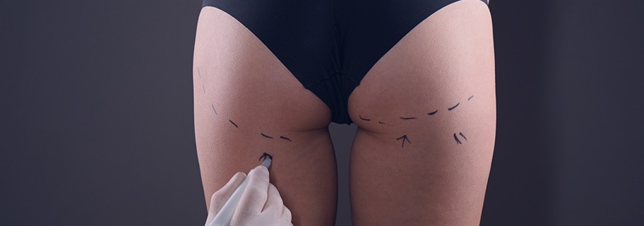 Buttock augmentation in Turkey: Procedure, Benefits, Types, and Cost