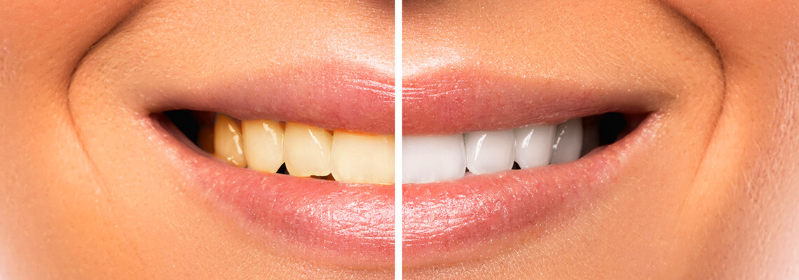 Teeth Whitening and Bleaching