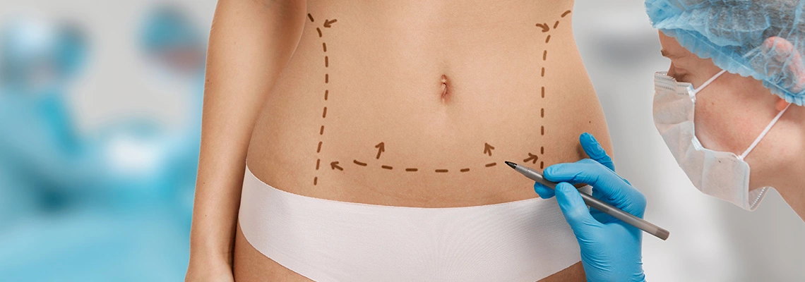 What does qualify you for a tummy tuck?