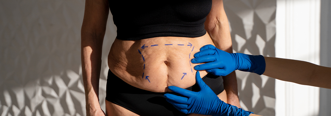 What liposuction technique is best? Efficiency, modern advancements, safety, and precision 