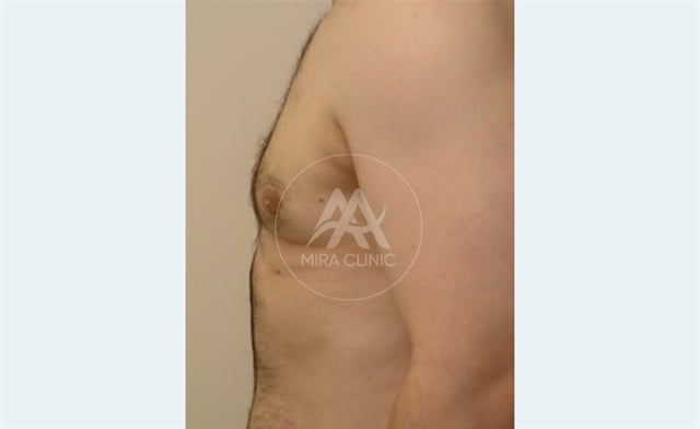 Before & After Gynecomastia