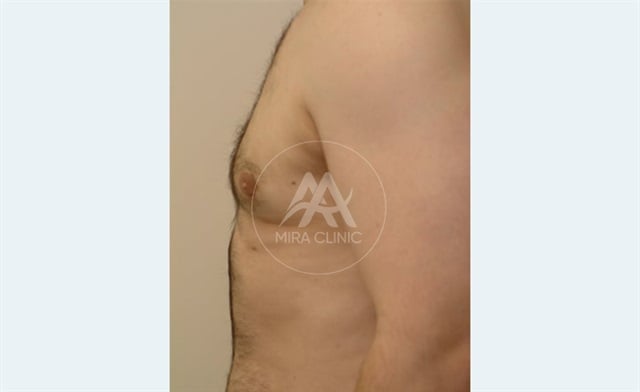 Avant après Gynecomastia