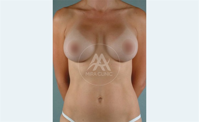 Before & After Breast Lift & Augmentation