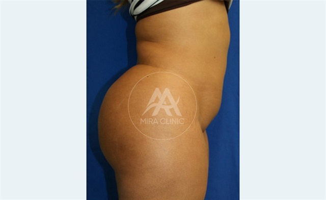 Before & After Buttock Augmentation