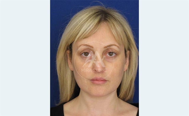 Eyelid Lift in Turkey 2025: Methods, Recovery, and Costs