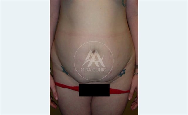 Avant après Abdominoplastie 