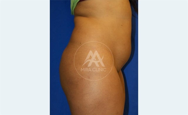 Before & After Buttock Augmentation 