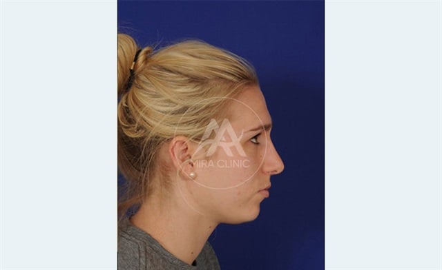 Avant après Rhinoplastie